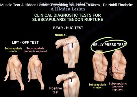 subscapularis tear lift off test|subscapularis test shoulder.